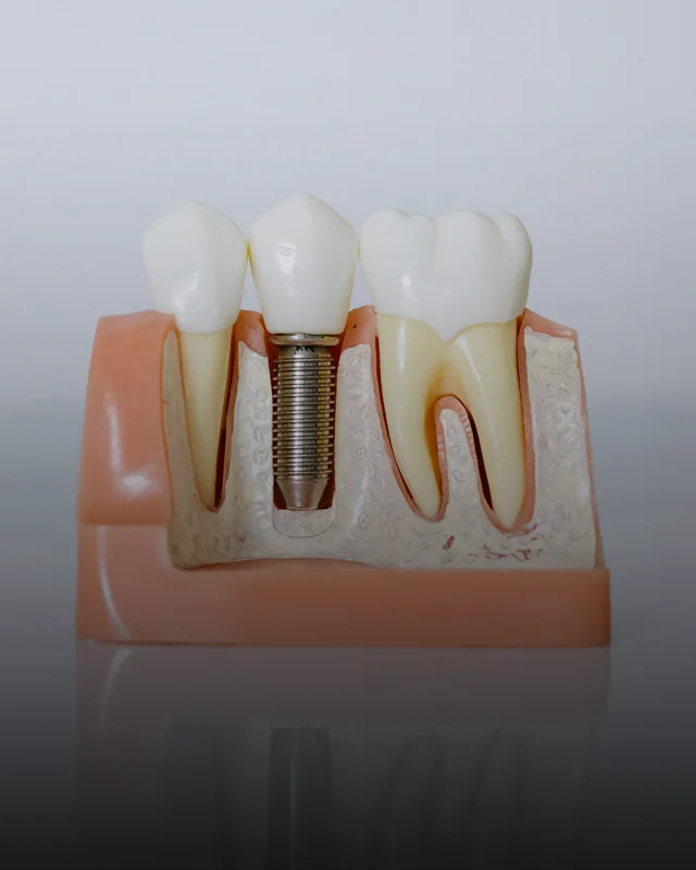 A model showing a dental implant installed between two natural teeth